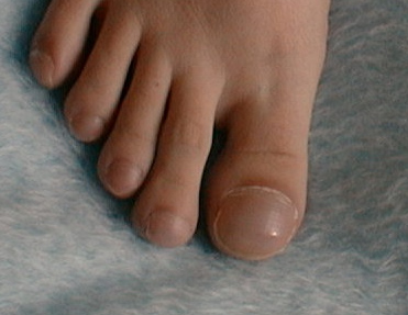 Желто-коричневая окраска ногтя (сантонихия)